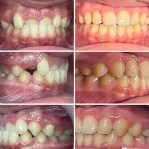 before-after-01