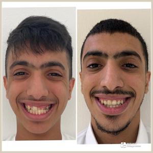 before-after-05